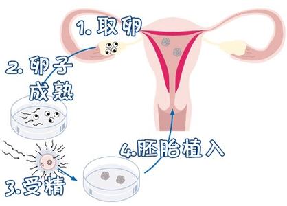 供卵试管代生